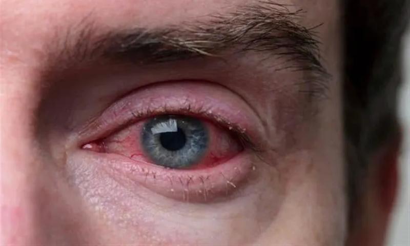 كل ما تُريد معرفته عن إنفلونزا العيون.. يمكن أن تؤدي لـ فقدان البصر