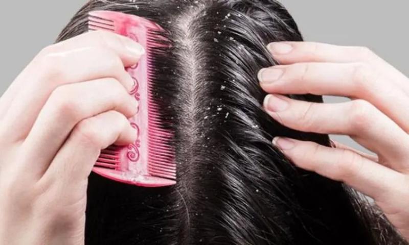 مشكلة الفتيات في الشتاء.. الحل النهائي لعلاج قشرة الشعر