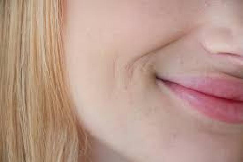 أسباب اسمرار حول الفم وطرق علاجها